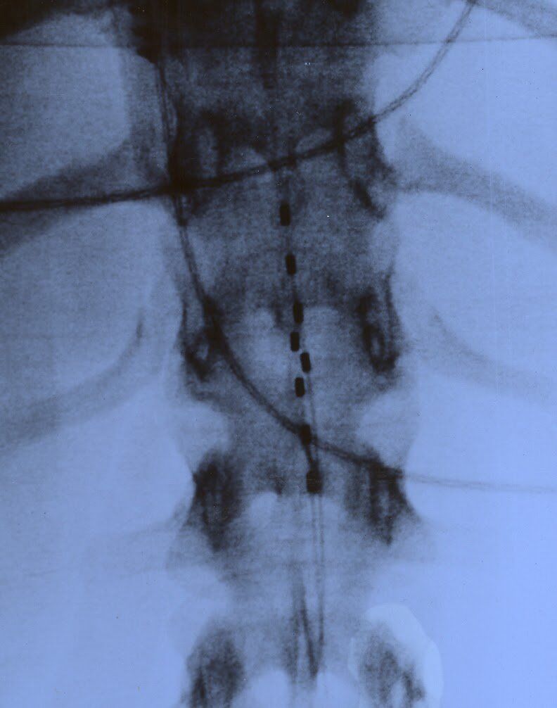 dorsal column stimulator