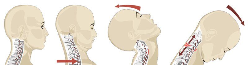 Whiplash diagram of spine as a common car accident injury