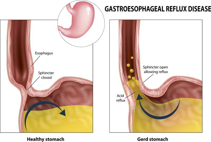 gerd upper abdominal pain