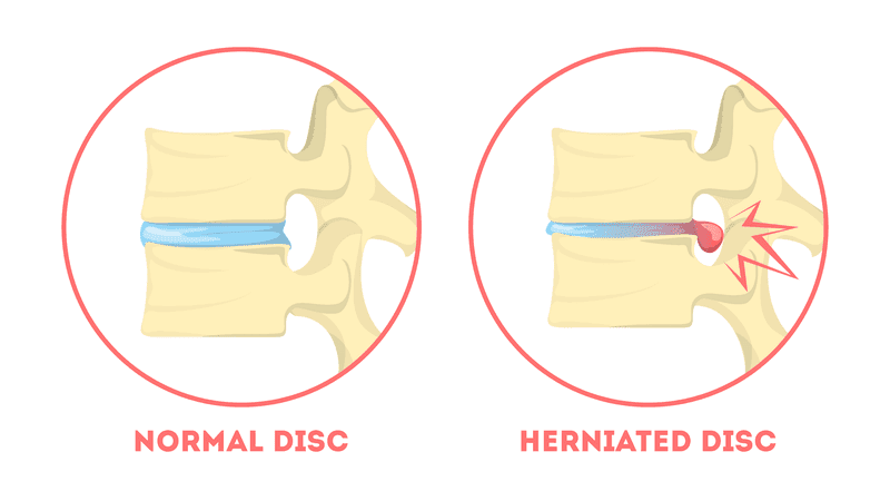 diagram of healthy spine and spine with herniated disc