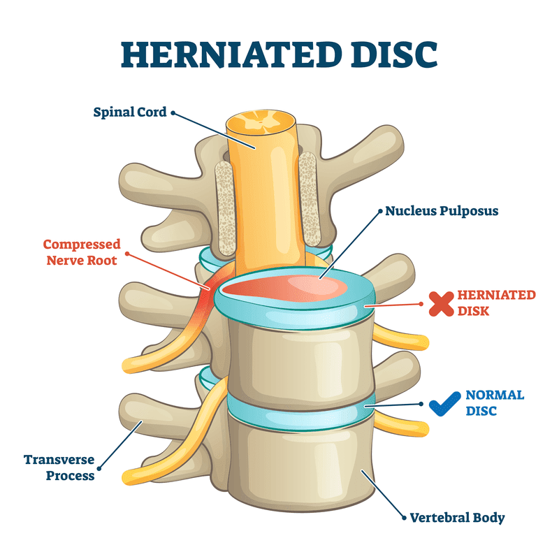herniated disc diagram