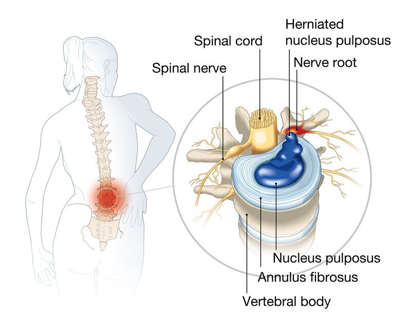 diagram of bulging disc pain