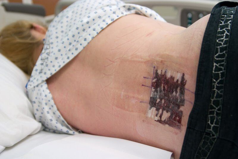 dorsal column stimulator recovery